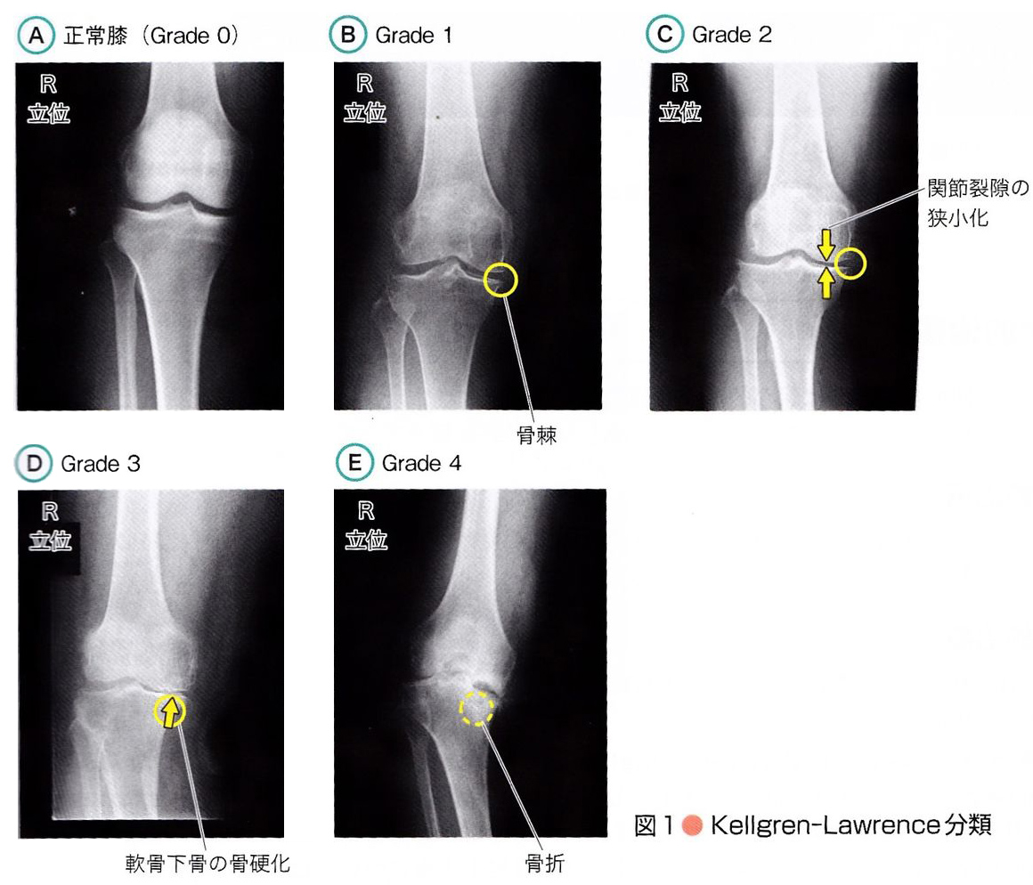 変形性膝関節法のグレード評価